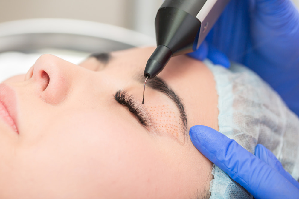 Plasma IQ: Revolução na Medicina Estética e Plástica Ocular